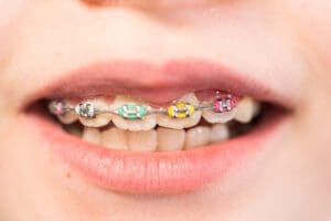 Close-up of the mouth of a girl with rainbow braces.