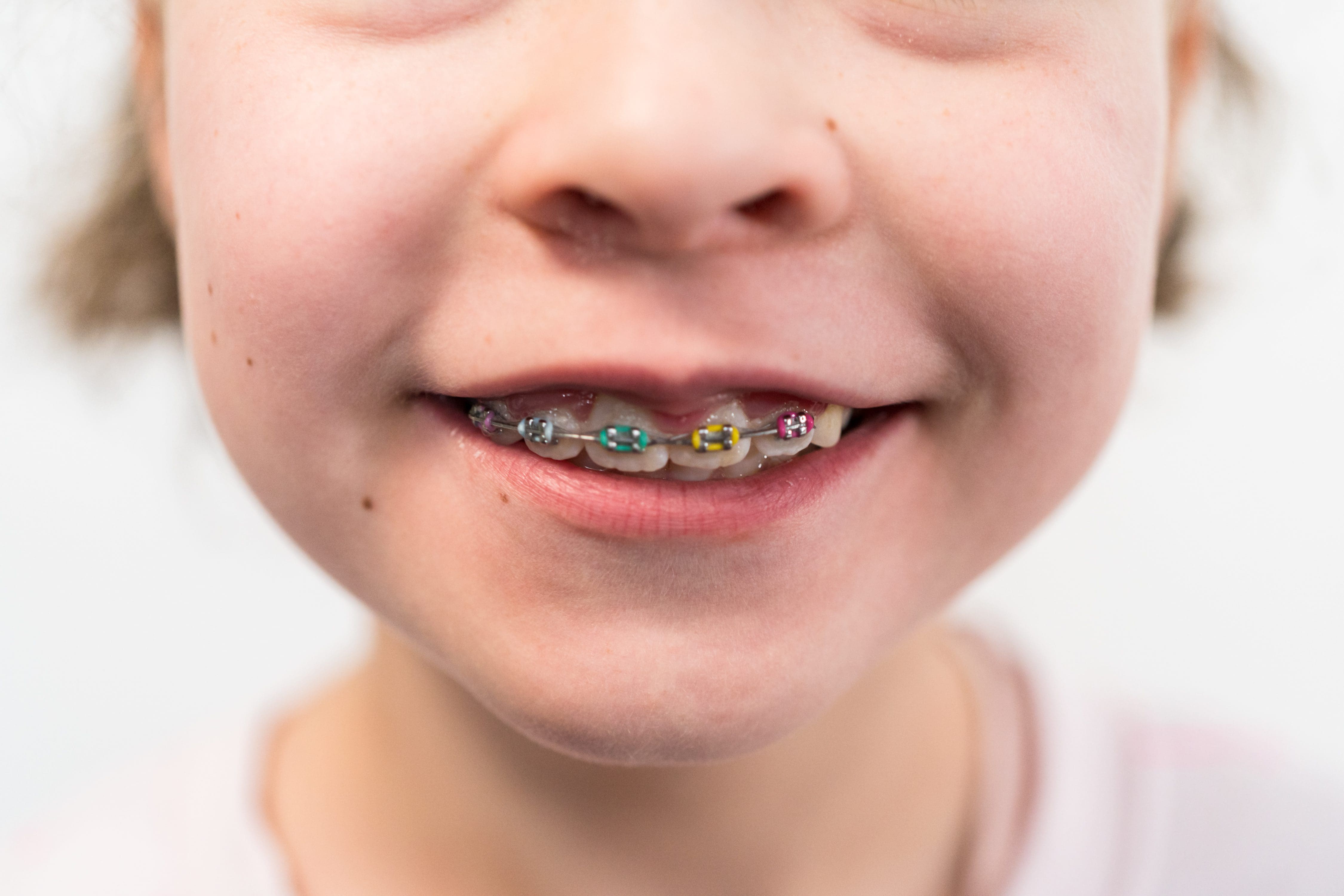 Close-up of the mouth of a girl with rainbow braces.