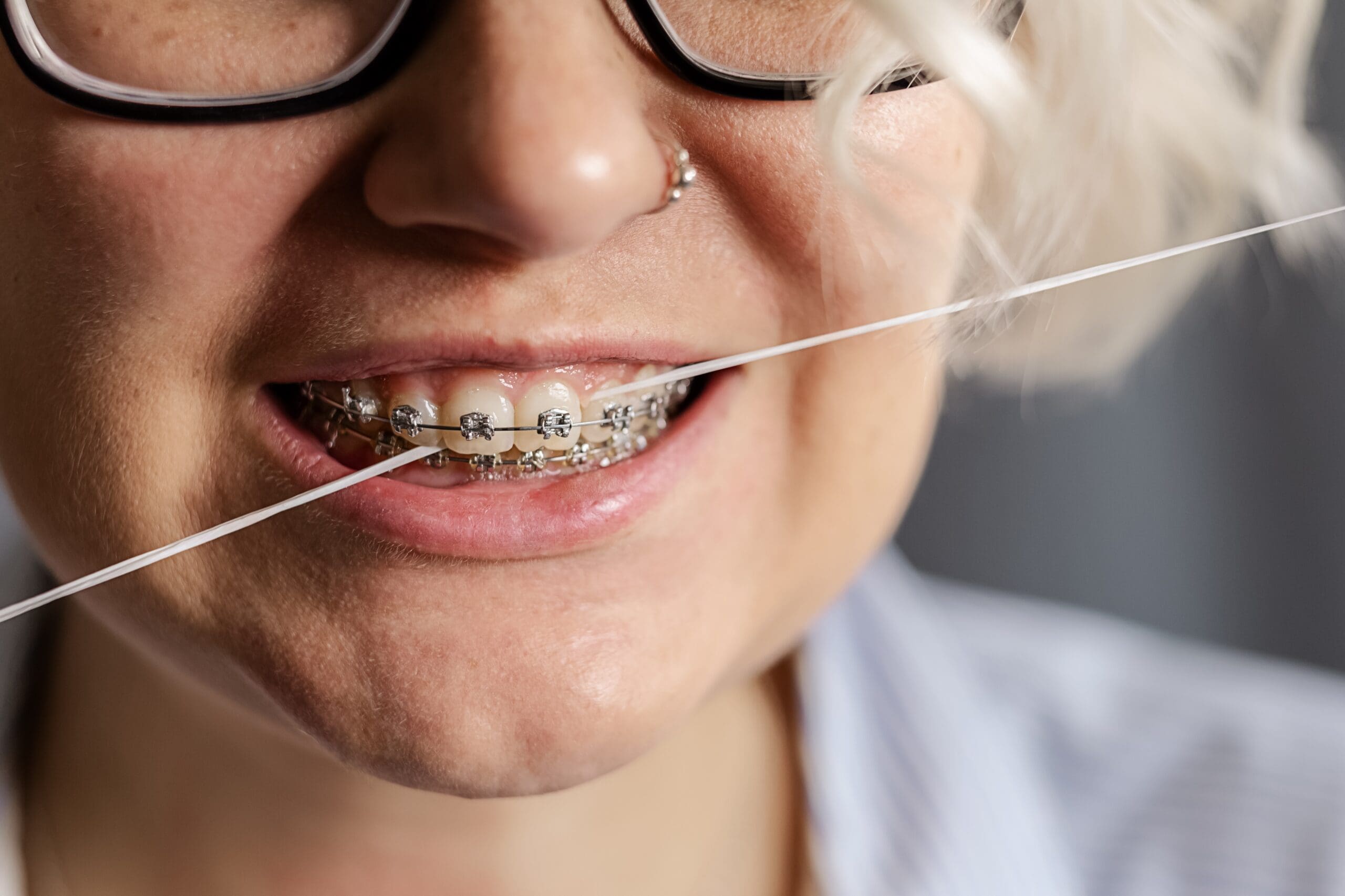 a-young-woman-with-braces-brushes-her-teeth-with-d-2023-11-27-04-51-44-utc