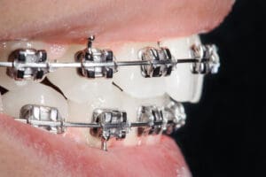 Close-up dental braces on teeth. Orthodontic Treatment