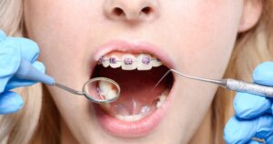 Cropped shot of dentist in latex gloves using a mouth mirror and periodontal probe on woman with