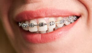 Female smile with metal braces on white teeth.