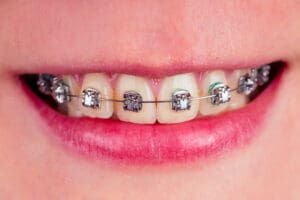 macro shot of white teeth with braces with green color spot