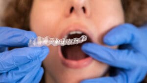 Orthodontist doctor putting silicone invisible transparent braces on woman teeth