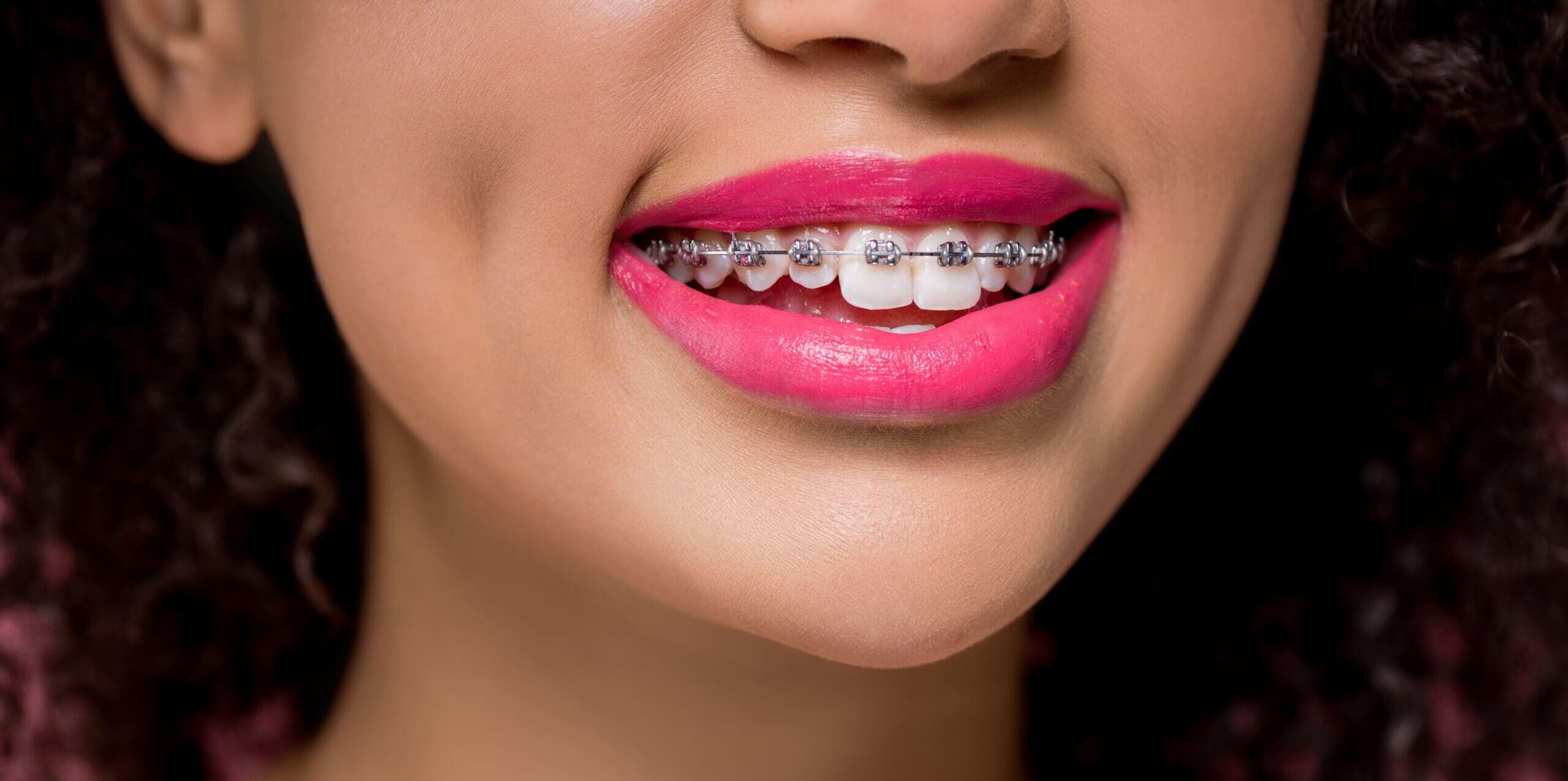 cropped view of smiling african american girl with dental braces and pink lips