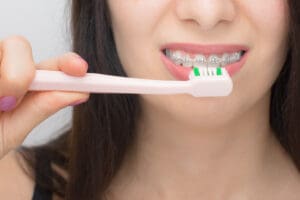 Happy woman clean teeth with dental braces by pink brush. Brackets on the teeth after whitening. Self-ligating brackets with metal ties and gray elastics or rubber bands for perfect smile