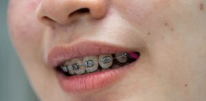 Braces in teenage girl mouth to treat and beauty for increase confidence and good personality.