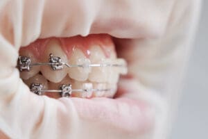 Macro photography of human's mouth with metal and ceramic braces on white teeth and cheek retractor. Isolated on white background. Concept of dental care