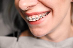 Close up of young woman with charming smile demonstrating white teeth with orthodontic brackets. Patient showing results of dental braces treatment. Concept of orthodontic treatment.