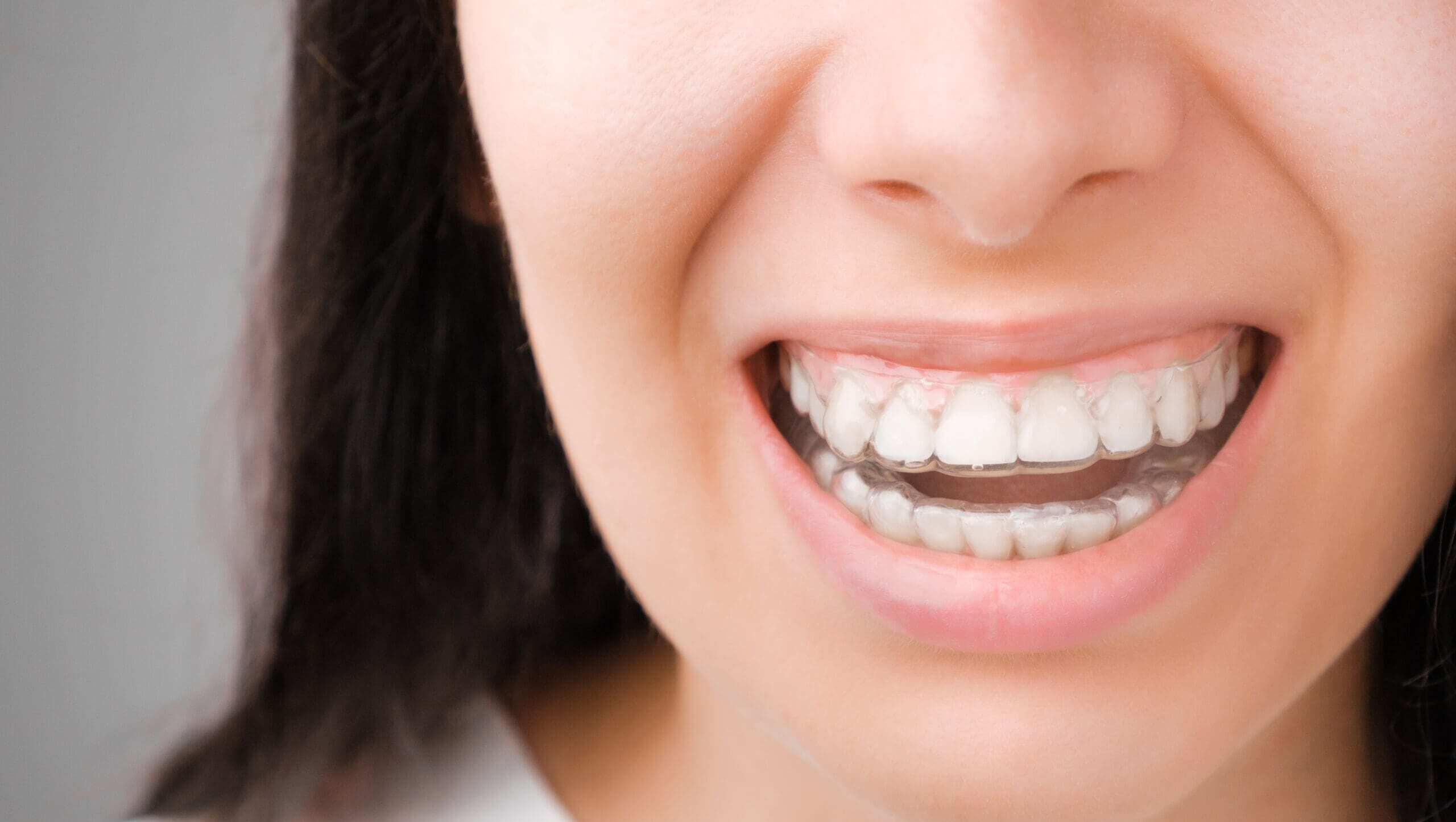 Happy woman with a perfect smile in transparent aligners on her teeth. Orthodontic treatment for whitening. Removable braces.