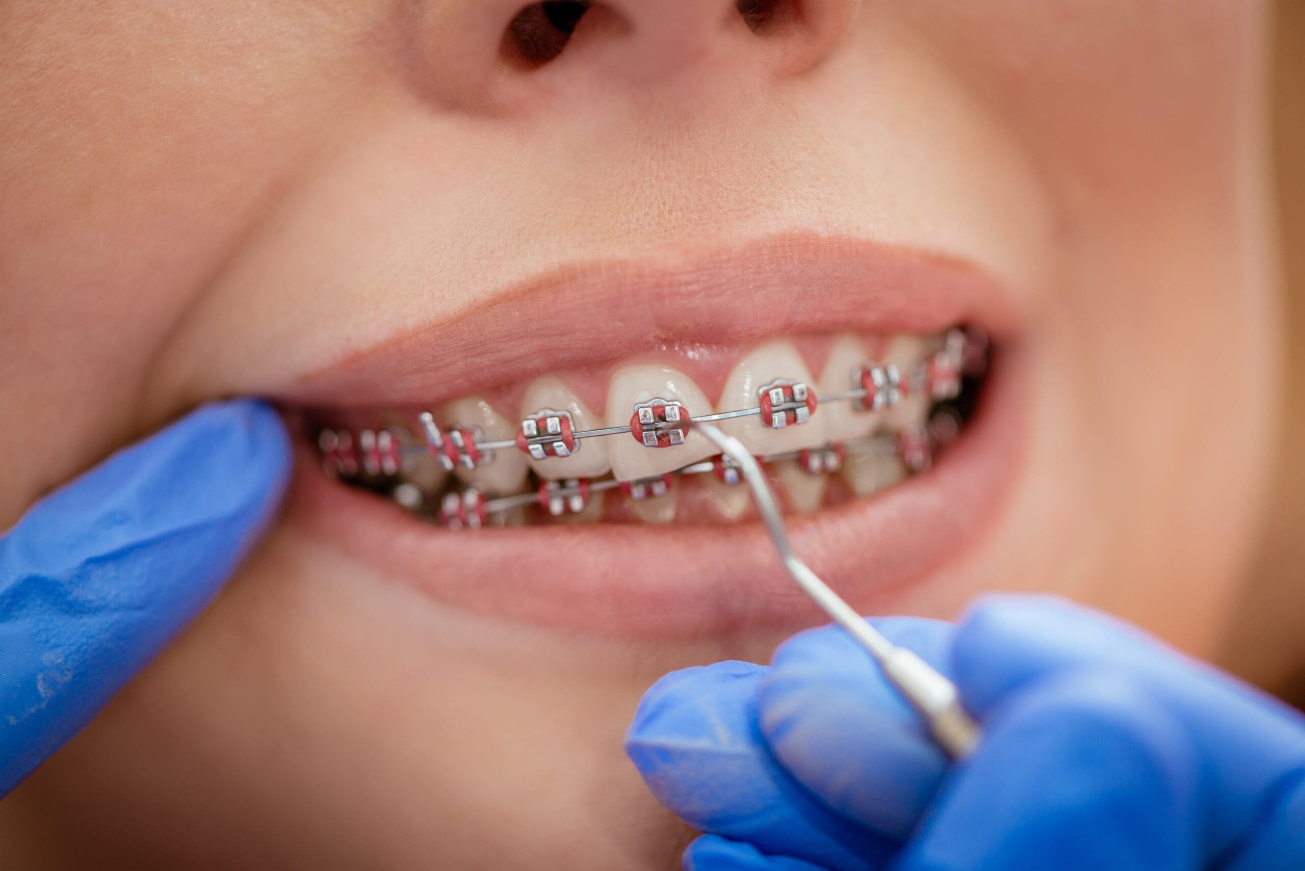braces