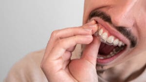 Male hand applying dental aligner retainer of dental clinic for beautiful teeth treatment. Orthodontic removable straighteners in dentist office.