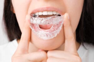 Smiling woman with perfect and healthy teeth using removable braces or aligner for straightening and whitening teeth. Orthodontic treatment for correction of bite