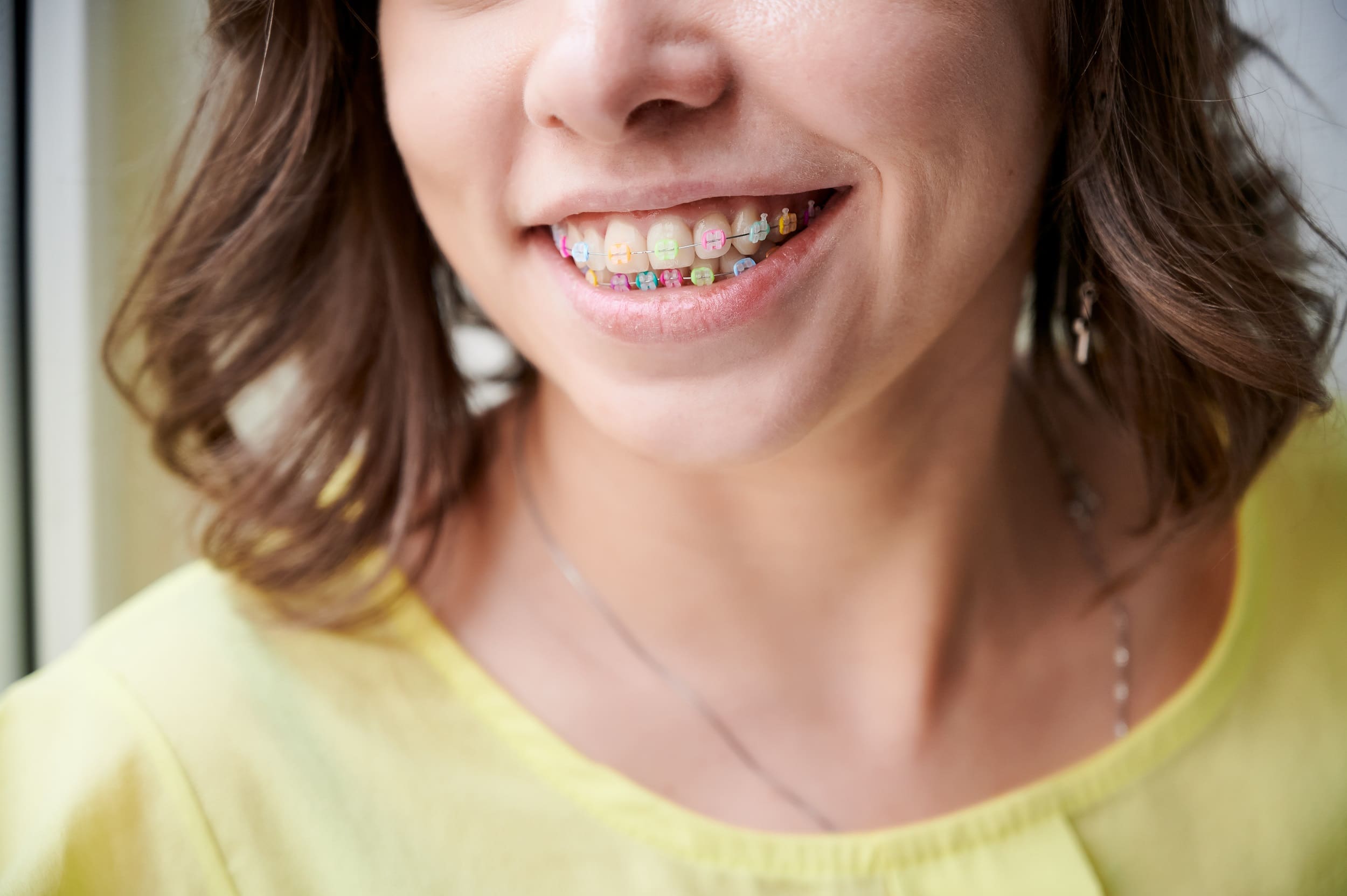 Close up of female patient smiling and showing brackets with multicolored rubber bands. 