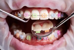 Orthodontist examining patient braces with dental instruments.