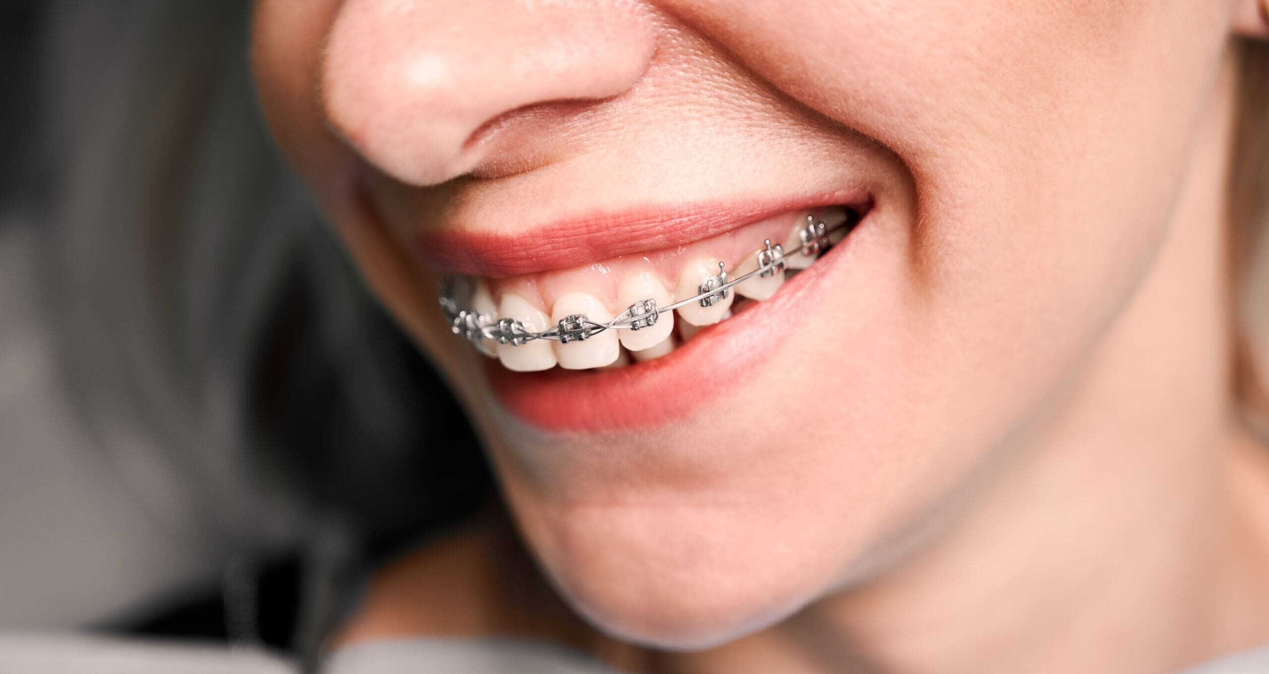 Close up of young woman with charming smile demonstrating white teeth with orthodontic brackets. Patient showing results of dental braces treatment. Concept of orthodontic treatment.