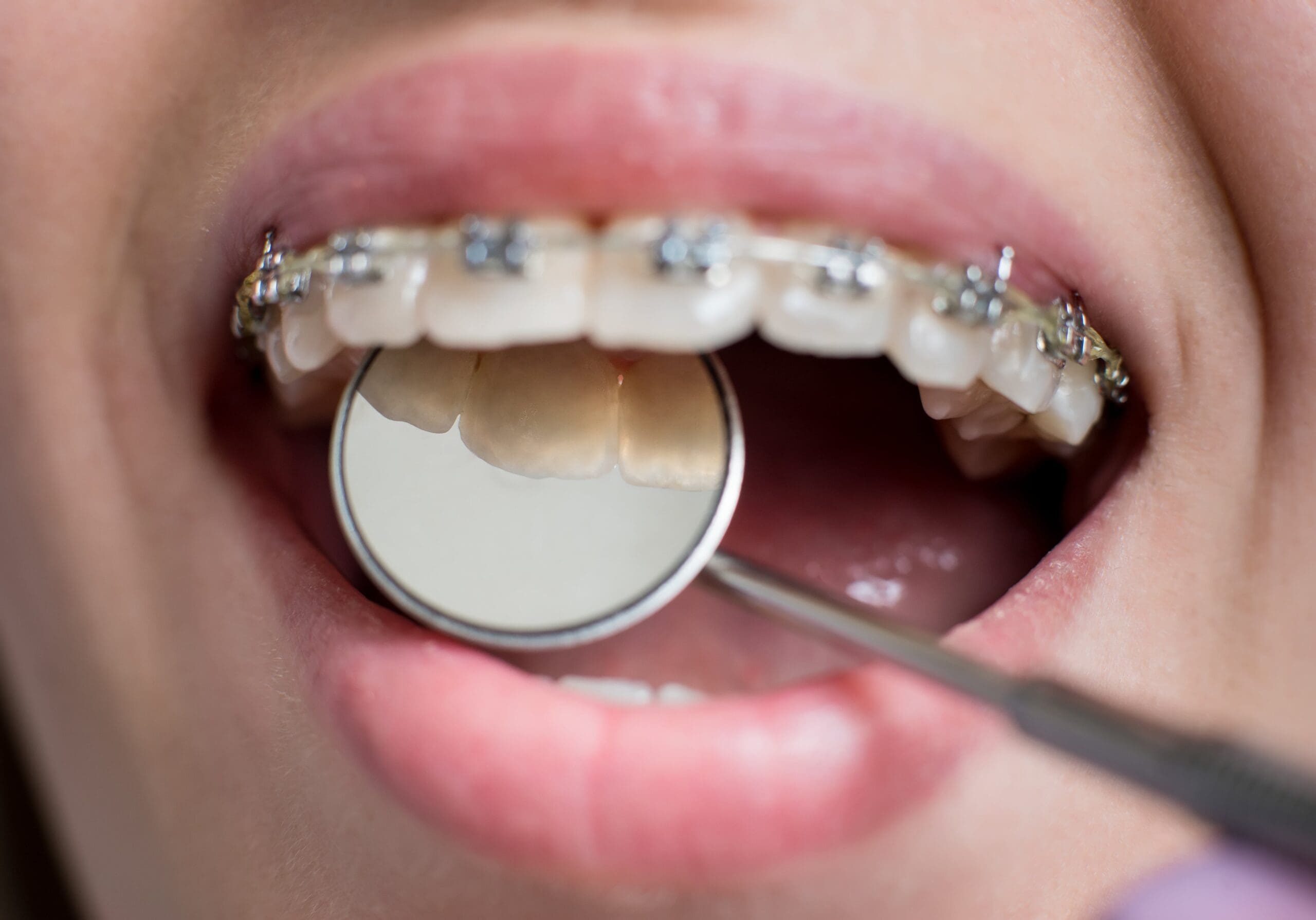 close-up-shot-of-teeth-with-braces-smiling-female-2025-01-16-22-29-16-utc-min