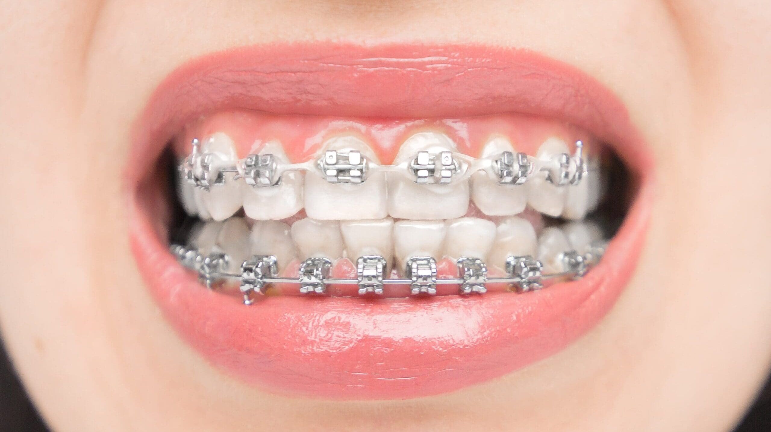 close-up-to-dental-braces-brackets-on-the-teeth-a-2025-03-06-21-55-12-utc-min