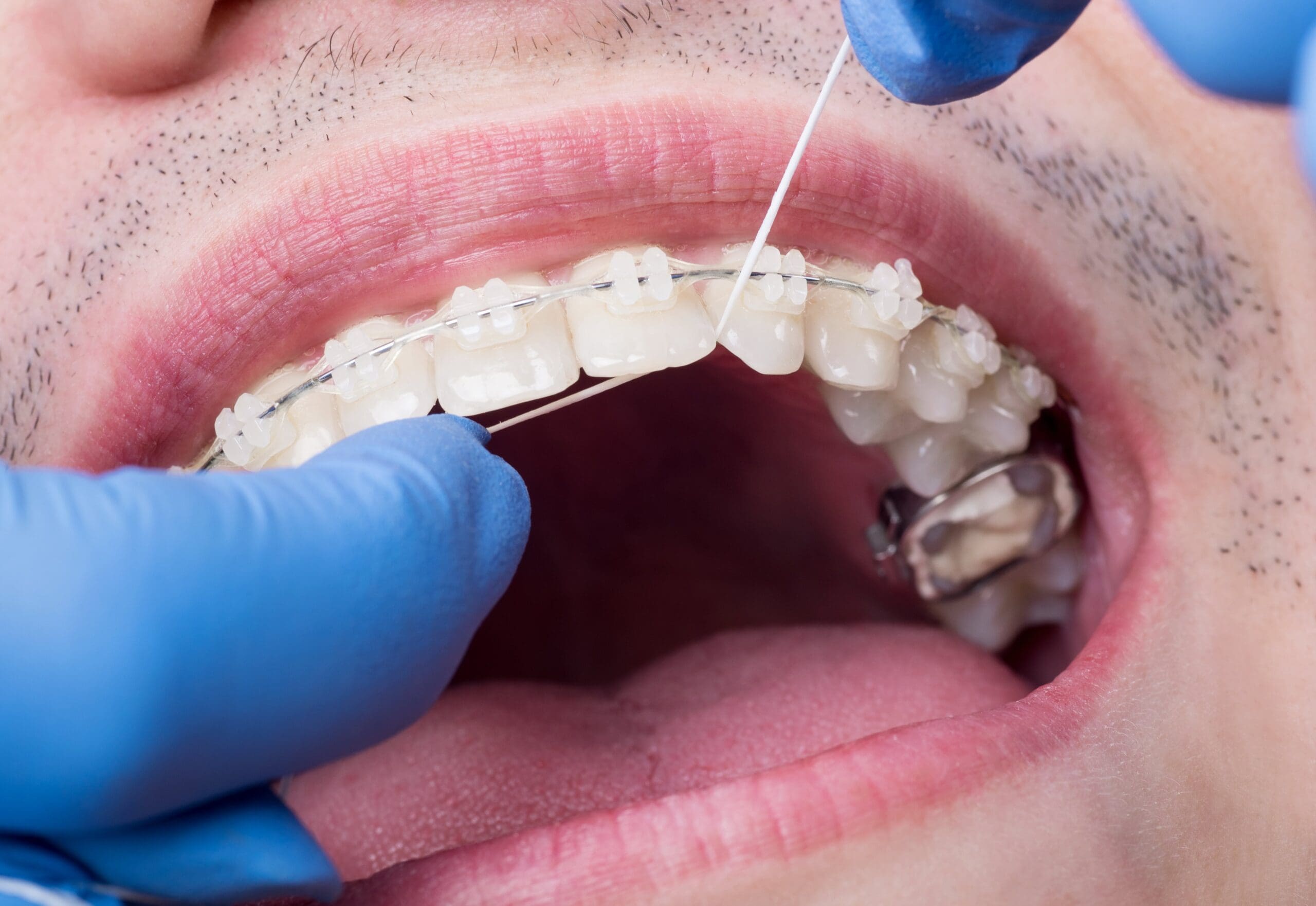 dentist-cleaning-teeth-with-ceramic-brackets-usin-2025-01-16-23-08-34-utc-min