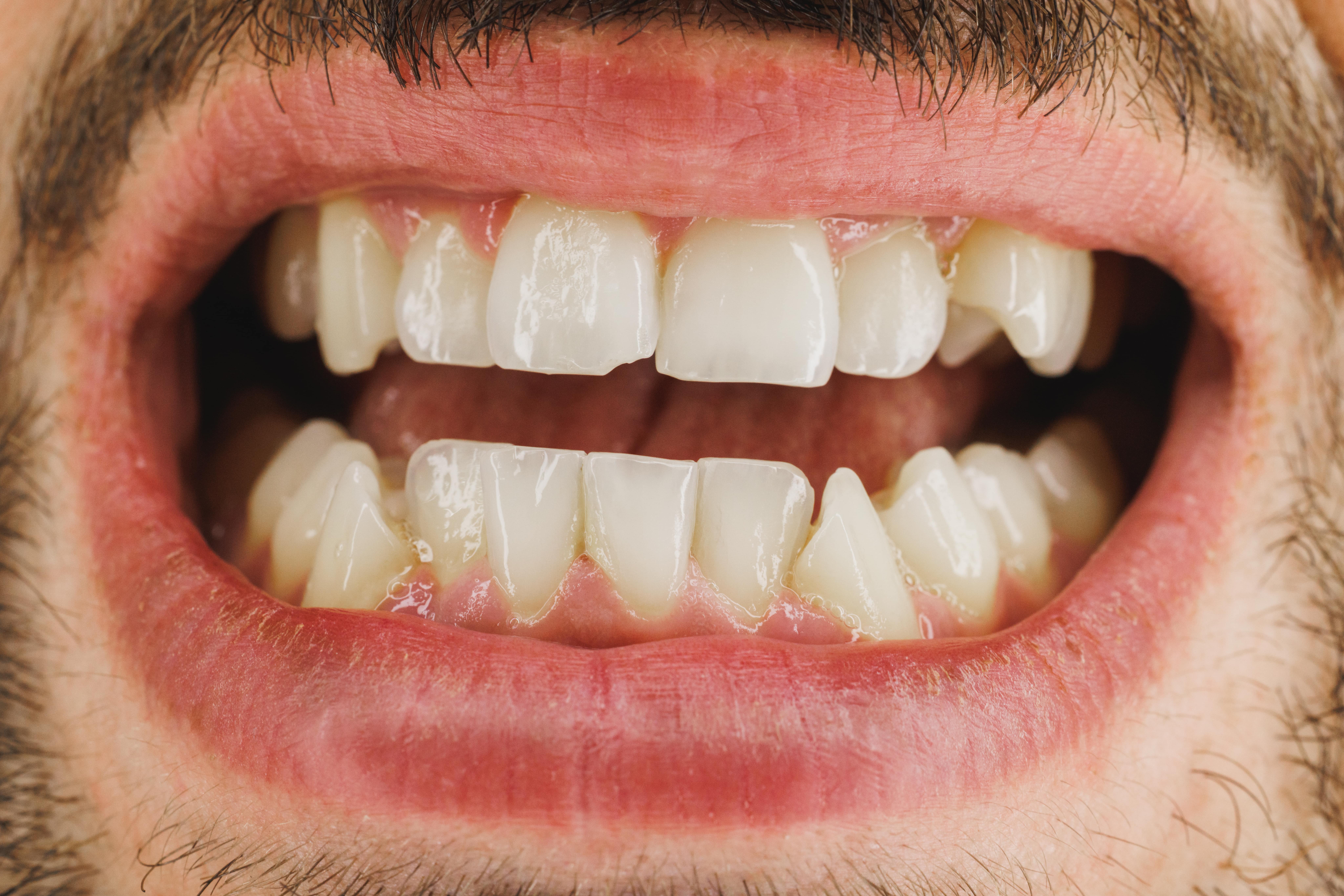 close-up-of-a-teeth-of-a-young-man-while-preparing-2024-10-19-00-48-27-utc-min