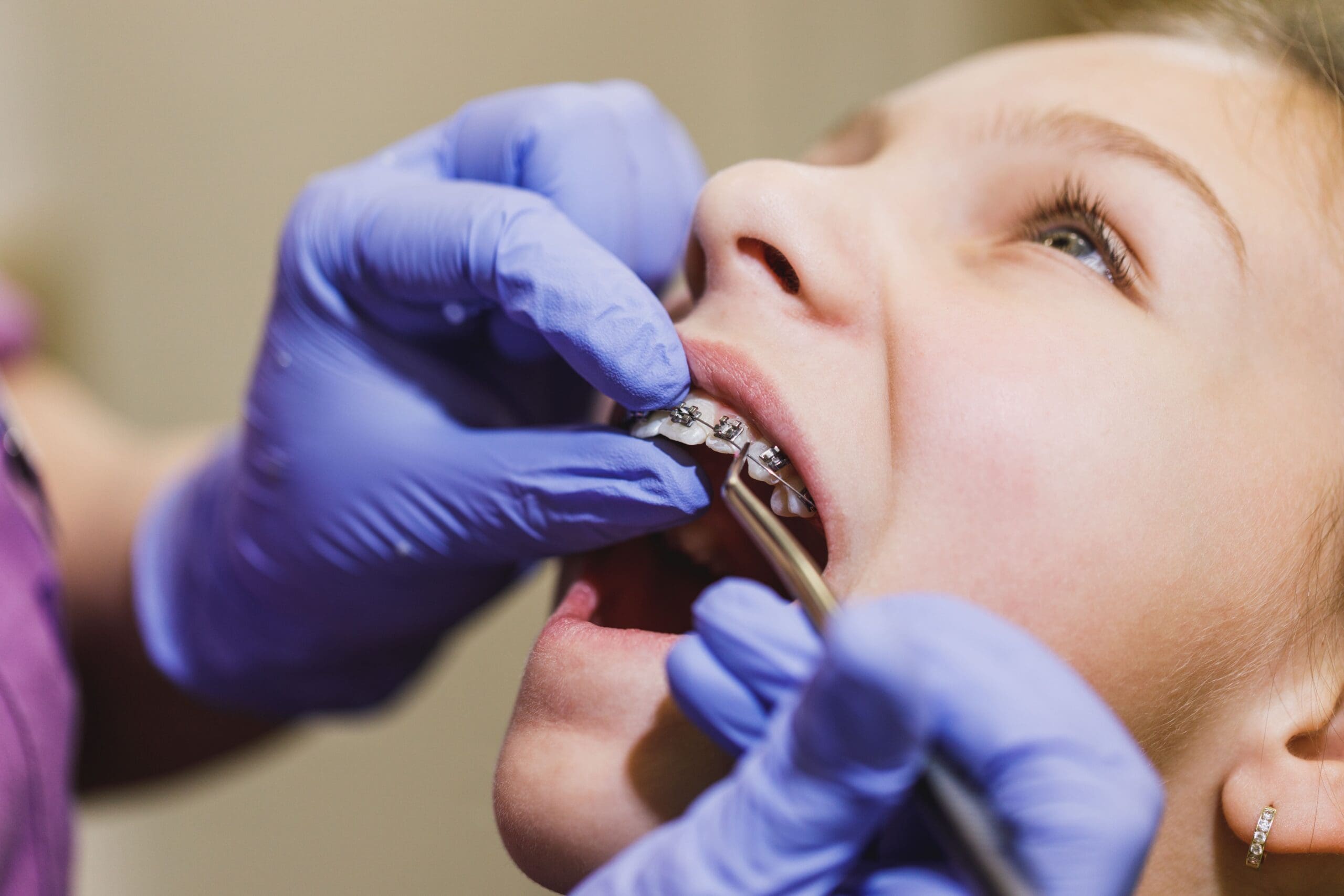 dental-braces-2024-10-18-10-05-17-utc (1)-min