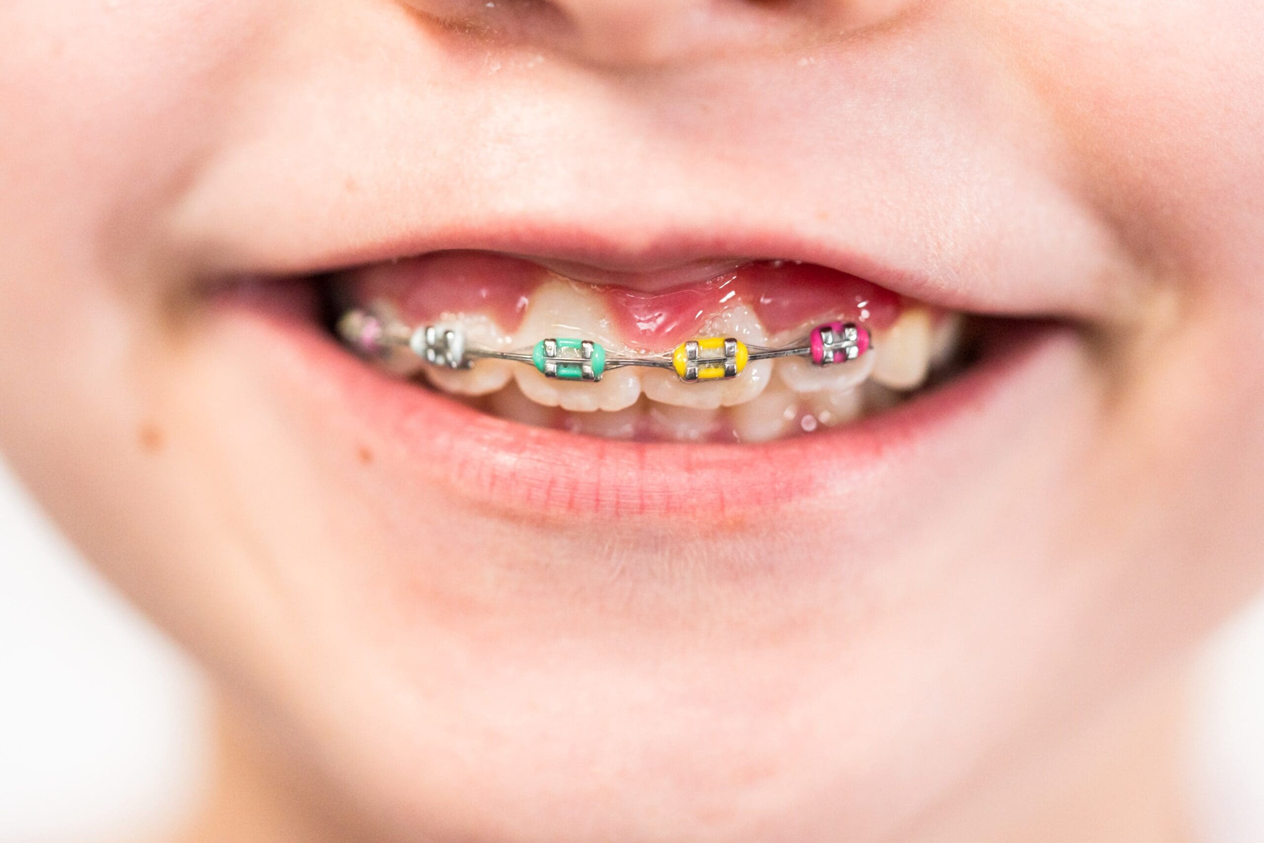 Little girl with rainbow braces
