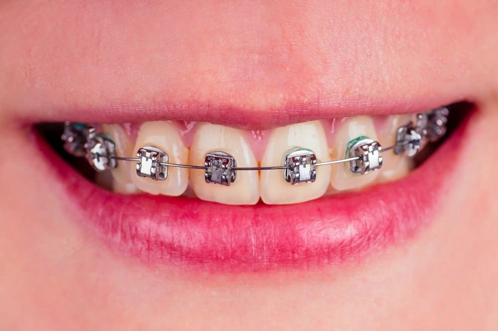 macro shot of white teeth with braces with green color spot.