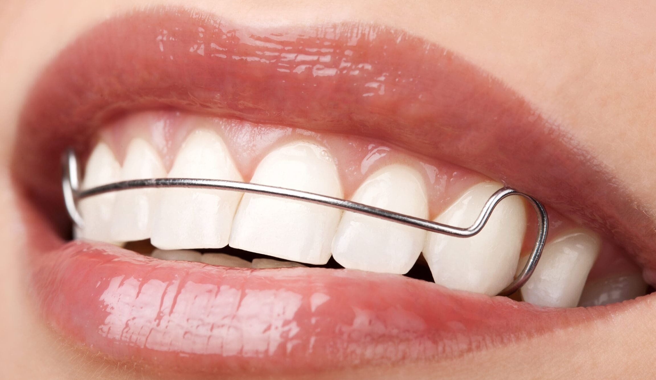 woman beautiful teeth with retainer orthodontic correction