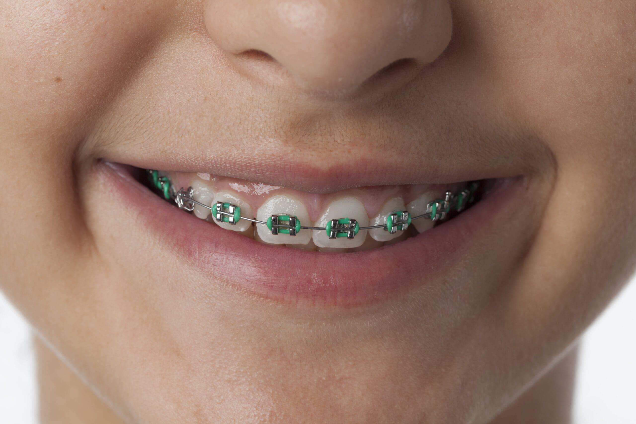 dental-braces-in-the-mouth-of-a-teenager
