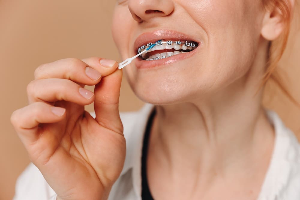 A person with braces in TX uses an interdental brush to clean between their teeth, highlighting the vibrant look of Colored Brace Bands Anna.