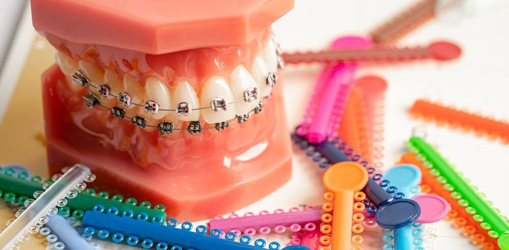A dental model with braces is surrounded by various colorful orthodontic elastic bands and tools, showcasing the variety of colored brace bands Anna offers in TX.