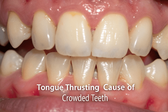 tongue-thrusting-cause-of-crowded-teeth-- (1) - Copy