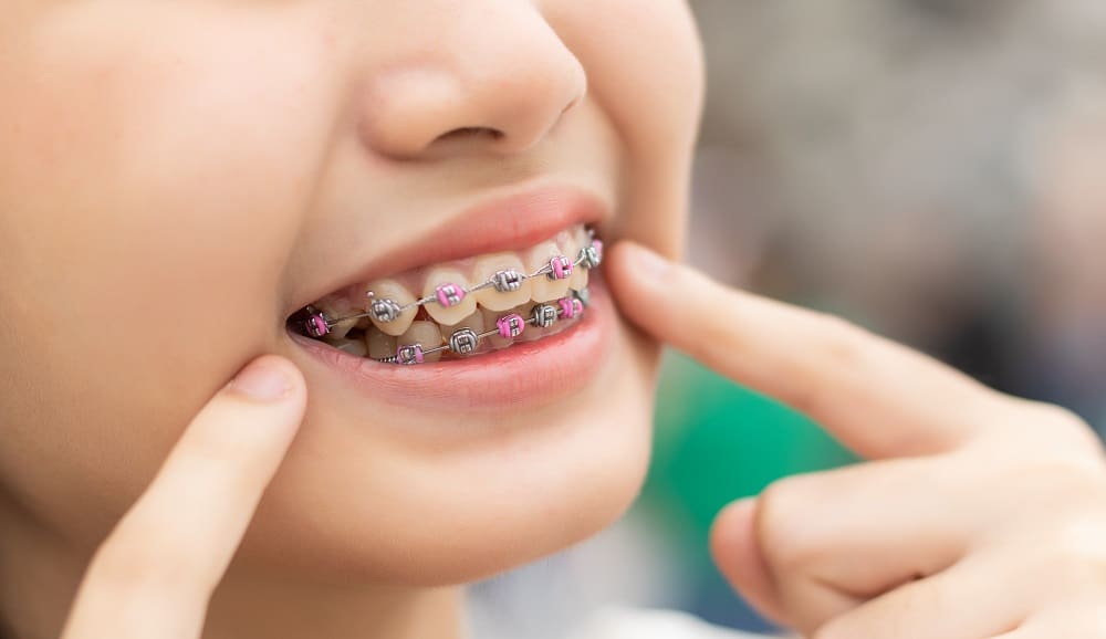 Close-up of a person smiling and pointing to their metal braces with pink and silver Colored Brace Bands in Anna, TX.