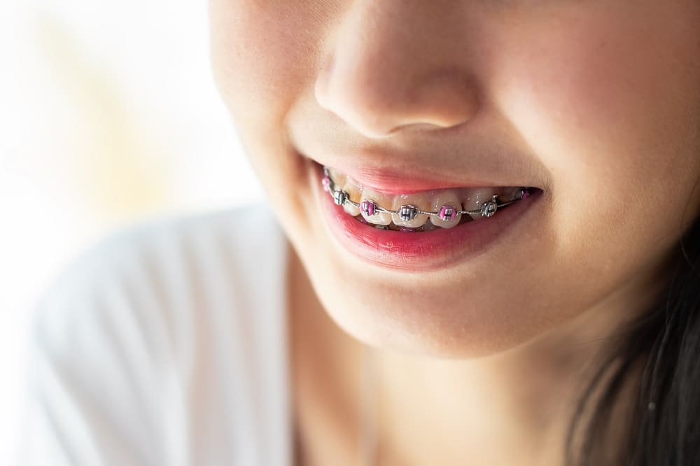  Close-up of a person smiling and showing metallic braces with Colored Brace Bands Anna on their teeth. The lower half of the face is visible, and they are wearing a white shirt in this vibrant TX moment.