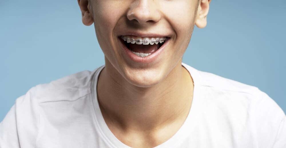 Excited, smiling boy with orthodontic braces, open mouth standing isolated on blue background, closeup. Concept of dental, treatment, health care
