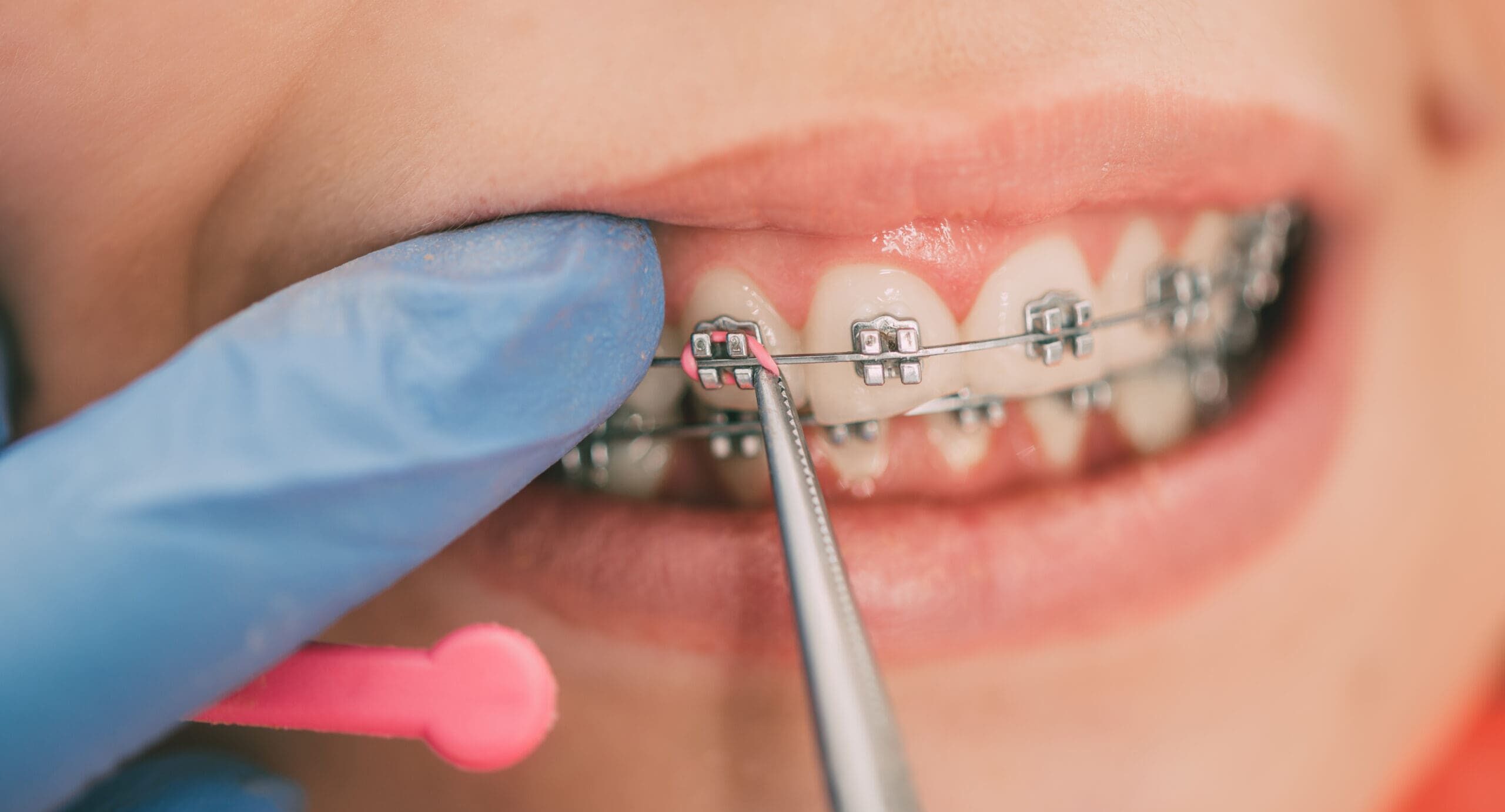 Dentist checking bracket at the braces on the female patient. Close-up. Real People.