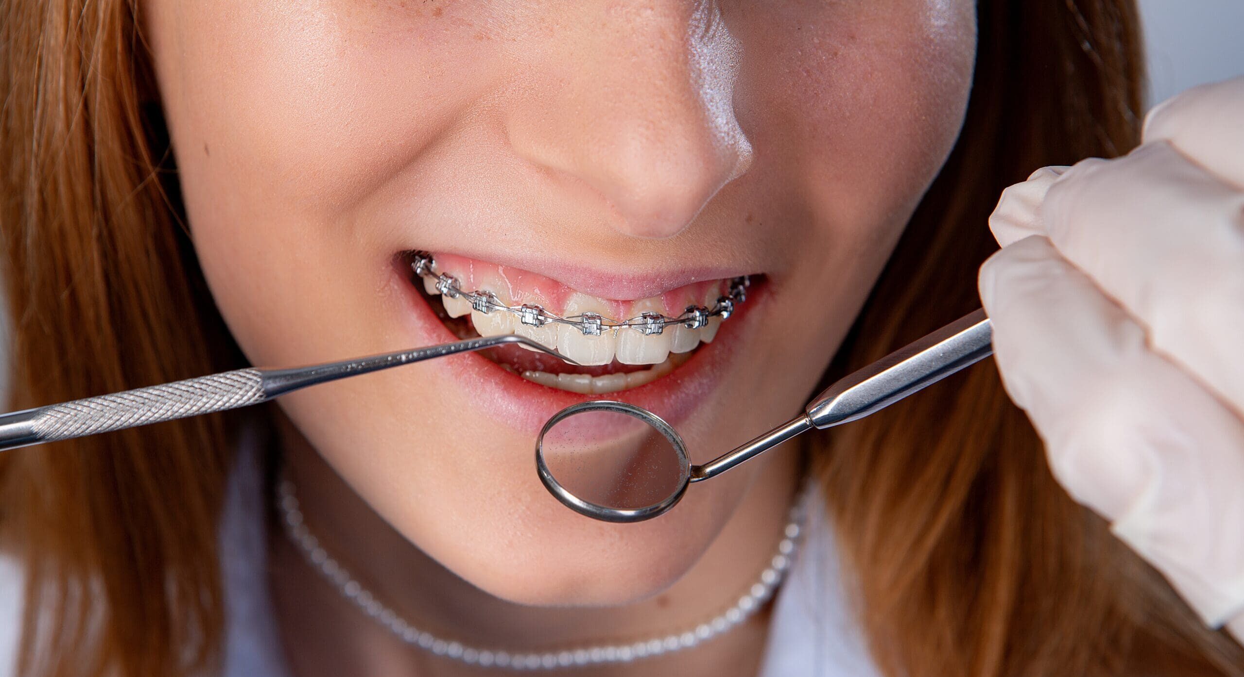dental-checkup-showing-white-teeth-with-braces-2026-03-16-06-20-25-utc