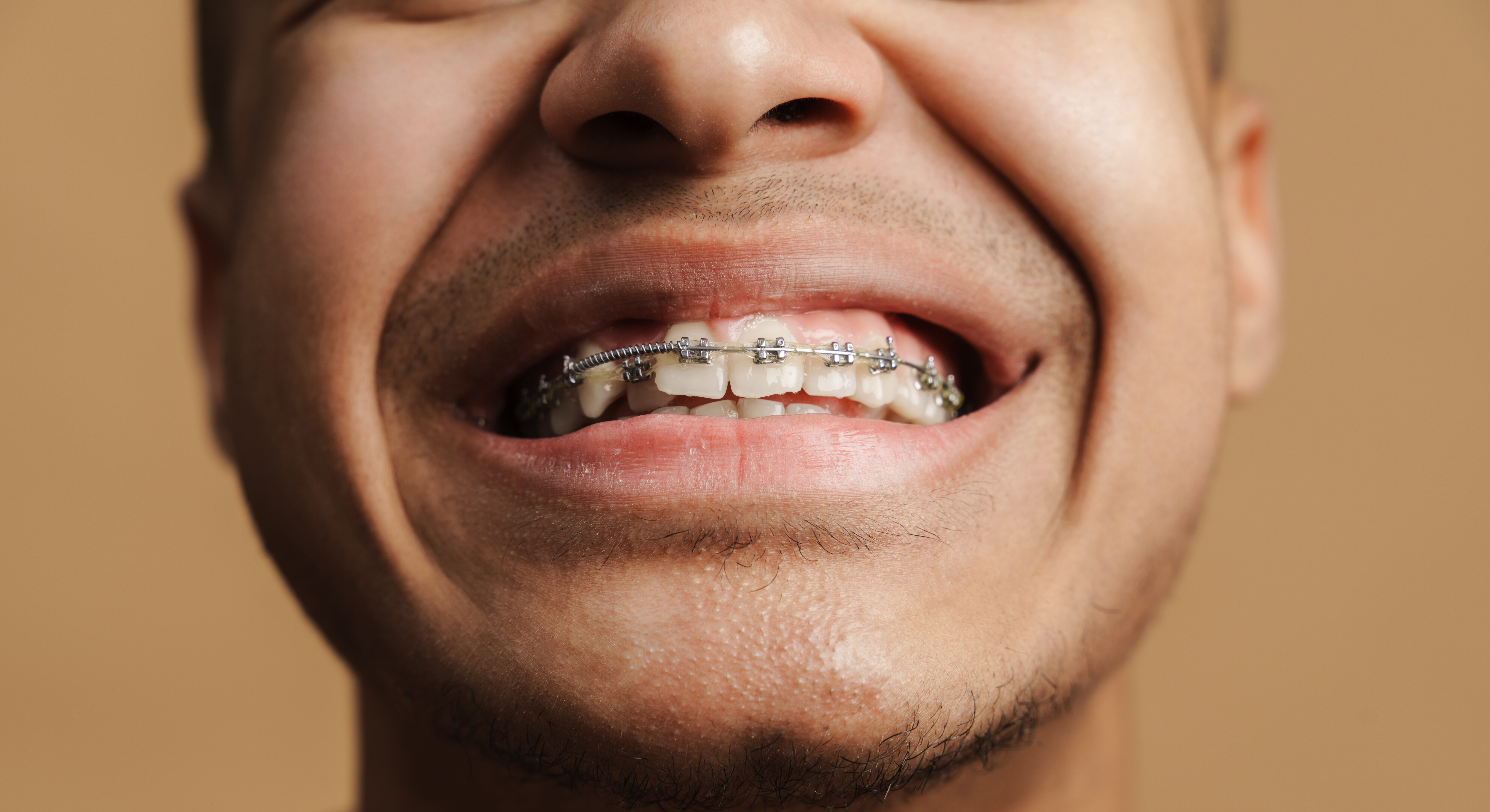 Young bristle man showing his dental brace at camera isolated over beige background